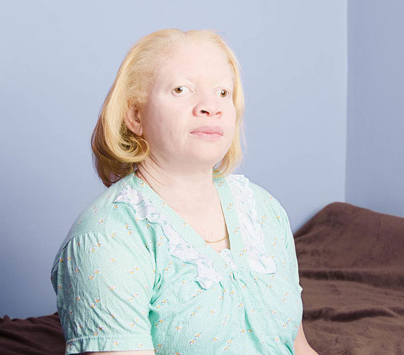 - Sok albínó állandóan sminkben jár, de engem nem zavar, ha az emberek a magam valójában látnak.